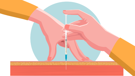 Illustration of injecting into the muscle (intramuscularly)